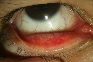 Conjuntivitis