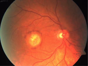Degeneración Macular Relacionada a la Edad