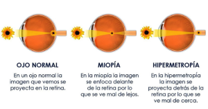 Miopía. Hipermetropía. Astigmatismo.